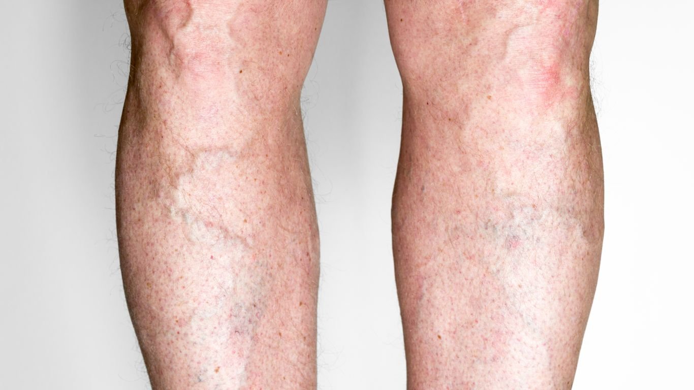 Do Men Get Varicose Veins